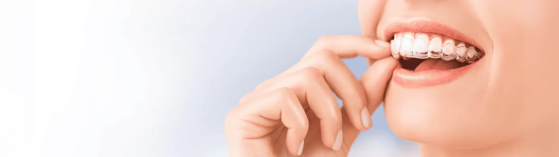 Invisalign Brisbane invisalign