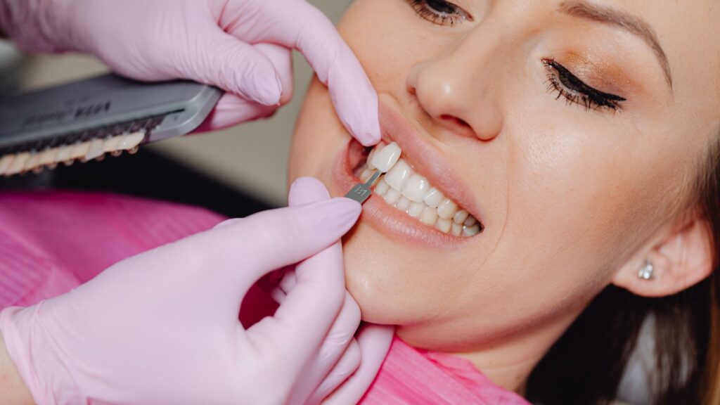 dental veneers