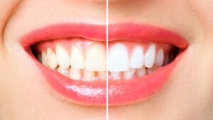 Professional Teeth Whitening