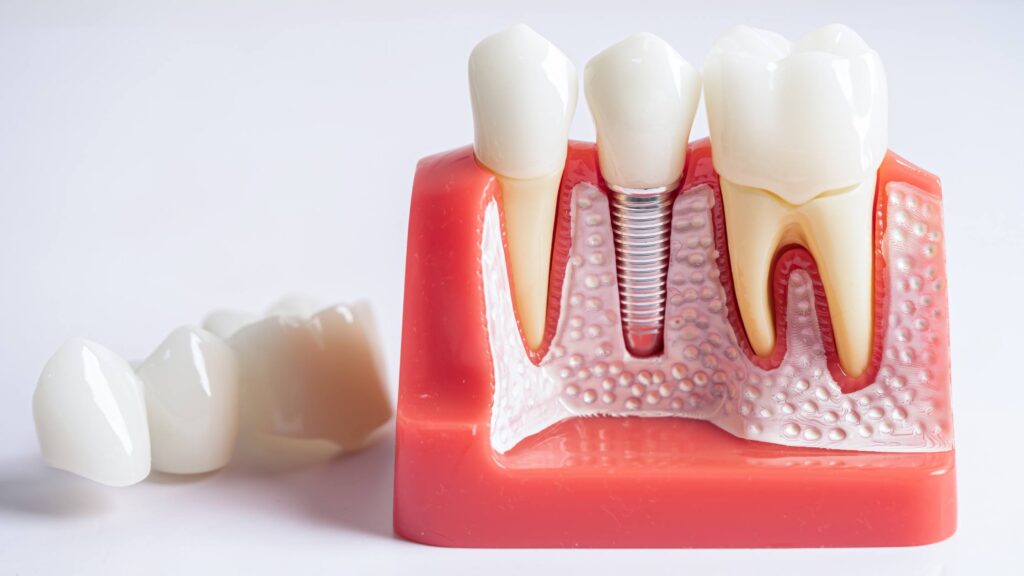 Dental Implants