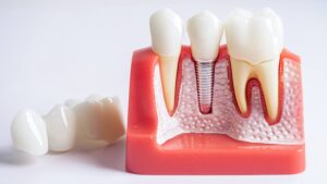 Dental Implants