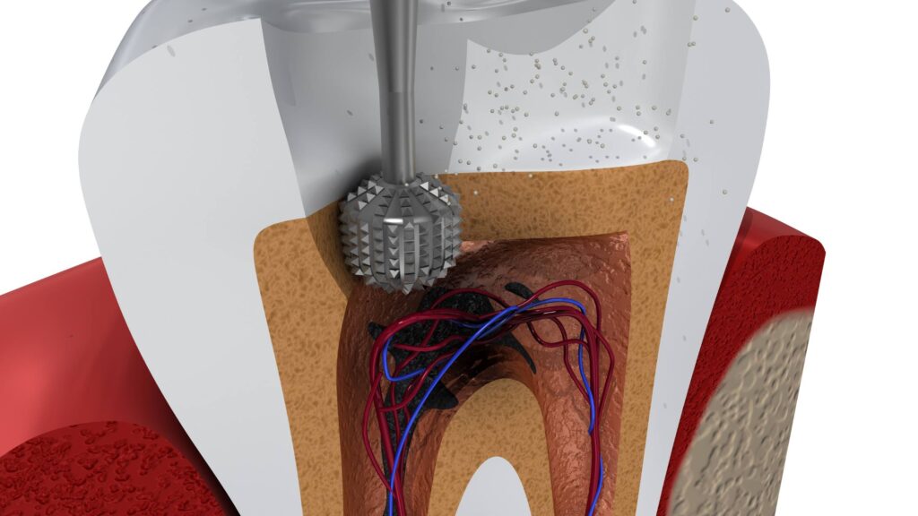 Root Canal
