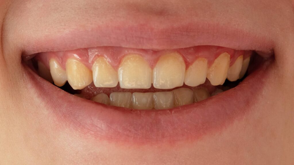 Why Do Teeth Get Discolored?