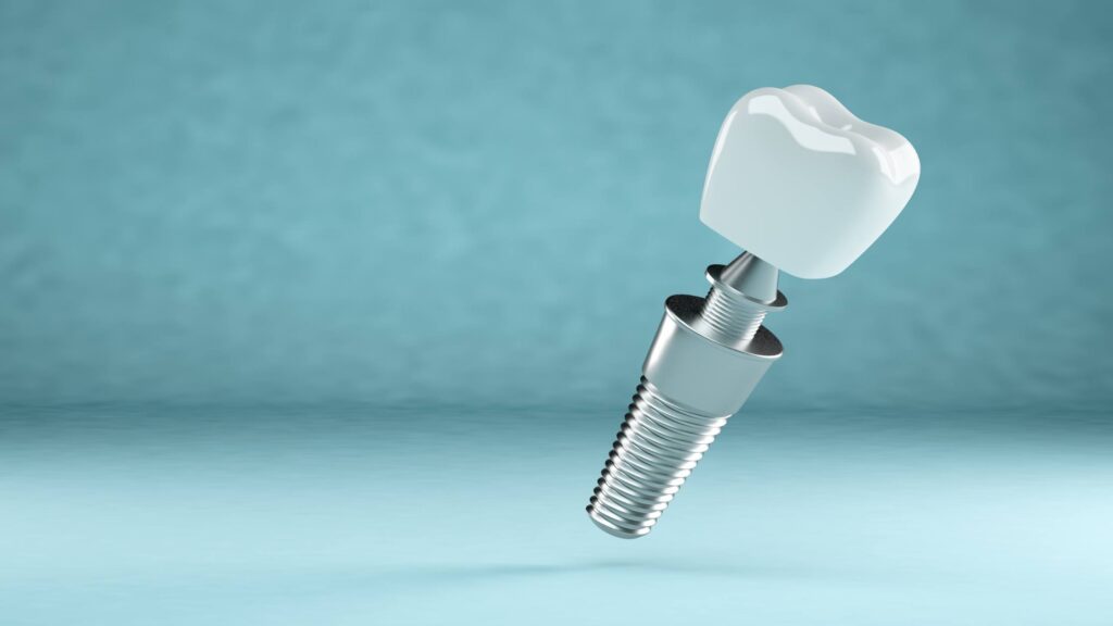 Dental Implants