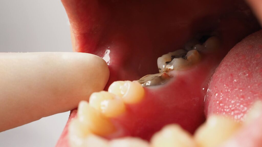 Root Canal