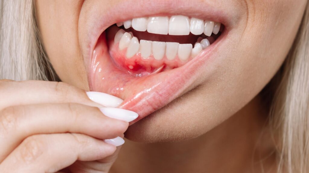 gum disease